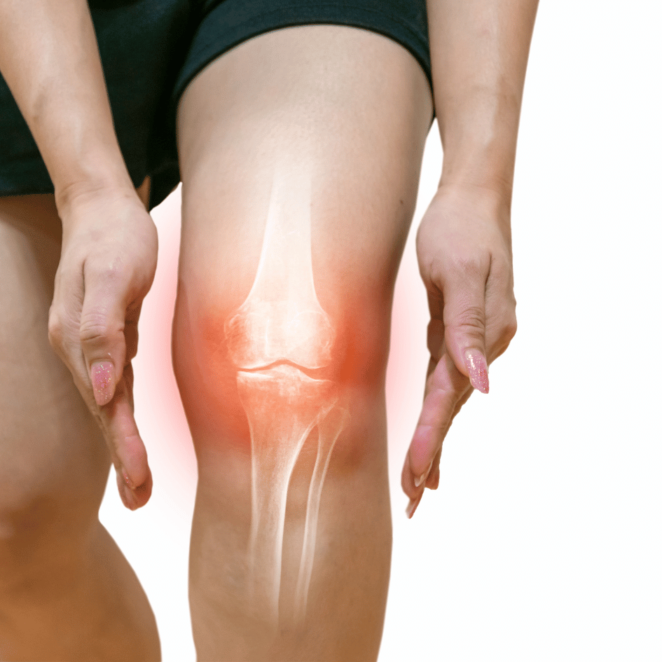 Image of knee joint pain and inflammation, highlighting Muira Puama’s (Ptychopetalum olacoides) potential in reducing inflammation, featured on Zaira Natural.